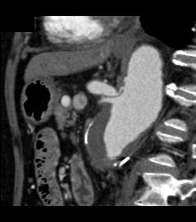 Abdominal Aortic Aneurysm (AAA) With Celiac Stenosis Due to Median Arcuate Ligament Compression. Note Post Stenotic Dilation of Celiac Artery. See Collaterals Through Gastroduodenal Artery (GDA)- Full Sequence of Images - CTisus CT Scan