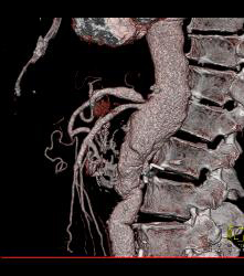 Abdominal Aortic Aneurysm (AAA) With Celiac Stenosis Due to Median Arcuate Ligament Compression. Note Post Stenotic Dilation of Celiac Artery. See Collaterals Through Gastroduodenal Artery (GDA)- Full Sequence of Images - CTisus CT Scan