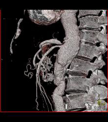 Abdominal Aortic Aneurysm (AAA) With Celiac Stenosis Due to Median Arcuate Ligament Compression. Note Post Stenotic Dilation of Celiac Artery. See Collaterals Through Gastroduodenal Artery (GDA)- Full Sequence of Images - CTisus CT Scan