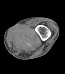 Occluded Graft With Bleed - CTisus CT Scan