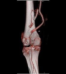 Occluded Graft With Bleed - CTisus CT Scan