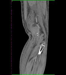 Occluded Graft With Bleed - CTisus CT Scan