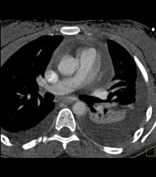 Pseudo Dissection of Aortic Root on Non-gated Study - CTisus CT Scan