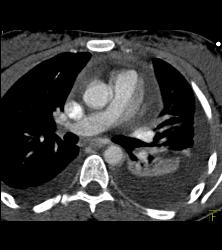 Pseudo Dissection of Aortic Root on Non-gated Study - CTisus CT Scan