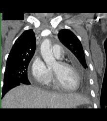 Pseudo Dissection of Aortic Root on Non-gated Study - CTisus CT Scan