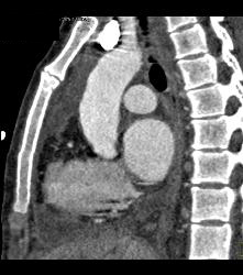 Pseudo Dissection of Aortic Root on Non-gated Study - CTisus CT Scan