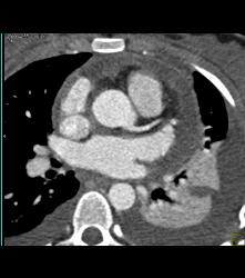 Same Patient With Gated Study and No Dissection - CTisus CT Scan