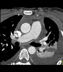 Same Patient With Gated Study and No Dissection - CTisus CT Scan