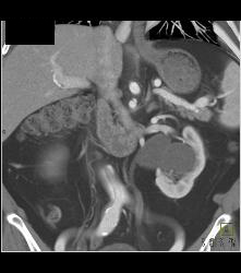 Aortic Dissection and Superior Mesenteric Artery (SMA) Dissection - CTisus CT Scan