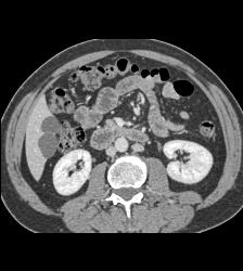 Duplicated Inferior Vena Cava (IVC) - CTisus CT Scan