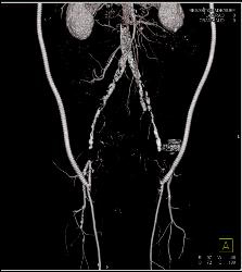 Bilateral Axillary-femoral Bypass Grafts for Occluded Infrarenal Aorta Multiple Visualizations - CTisus CT Scan