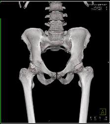 Bilateral Axillary-femoral Bypass Grafts for Occluded Infrarenal Aorta Multiple Visualizations - CTisus CT Scan