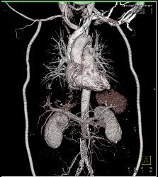 Bilateral Axillary-femoral Bypass Grafts for Occluded Infrarenal Aorta Multiple Visualizations - CTisus CT Scan