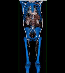 Bilateral Axillary-femoral Bypass Grafts for Occluded Infrarenal Aorta Multiple Visualizations - CTisus CT Scan