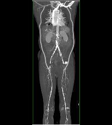 Bilateral Axillary-femoral Bypass Grafts for Occluded Infrarenal Aorta Multiple Visualizations - CTisus CT Scan