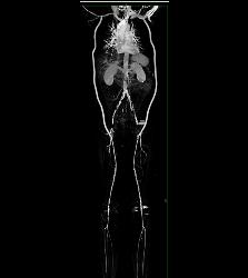 Bilateral Axillary-femoral Bypass Grafts for Occluded Infrarenal Aorta Multiple Visualizations - CTisus CT Scan