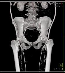 Bilateral Axillary-femoral Bypass Grafts for Occluded Infrarenal Aorta Multiple Visualizations - CTisus CT Scan