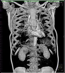 Bilateral Axillary-femoral Bypass Grafts for Occluded Infrarenal Aorta Multiple Visualizations - CTisus CT Scan