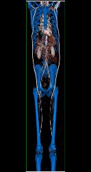 Bilateral Axillary-femoral Bypass Grafts for Occluded Infrarenal Aorta Multiple Visualizations - CTisus CT Scan