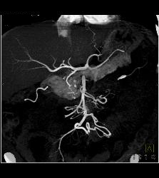 Chronic Pancreatitis Compresses the Gastroduodenal Artery (GDA) - CTisus CT Scan