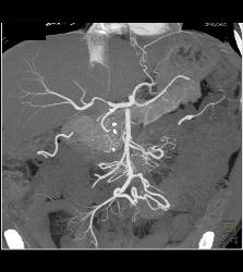 Chronic Pancreatitis Compresses the Gastroduodenal Artery (GDA) - CTisus CT Scan