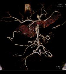 Chronic Pancreatitis Compresses the Gastroduodenal Artery (GDA) - CTisus CT Scan