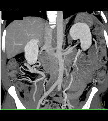 Carcinoid Tumor With Desmoplastic Reaction and Portal Vein Occlusion With Cavernous Transformation of the Portal Vein (CTPV) - CTisus CT Scan