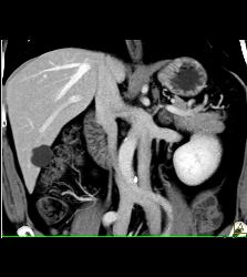 Duplicated Inferior Vena Cava (IVC) - CTisus CT Scan