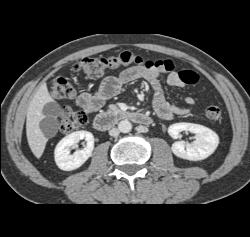 Duplicated Inferior Vena Cava (IVC) - CTisus CT Scan