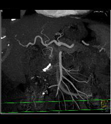 Coiled Gastroduodenal Artery (GDA) Aneurysm. See the Pre-embolization Study as Well- to Follow. Patient Also Had Portal Vein Thrombosis (PVT) - CTisus CT Scan