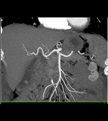 Coiled Gastroduodenal Artery (GDA) Aneurysm. See the Pre-embolization Study as Well- to Follow. Patient Also Had Portal Vein Thrombosis (PVT) - CTisus CT Scan