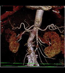 Coiled Gastroduodenal Artery (GDA) Aneurysm. See the Pre-embolization Study as Well- to Follow. Patient Also Had Portal Vein Thrombosis (PVT) - CTisus CT Scan