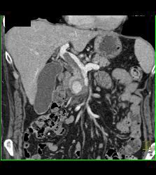 Gastroduodenal Artery (GDA) Pseudoaneurysm Simulates An Islet Cell Tumor - CTisus CT Scan