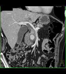 Gastroduodenal Artery (GDA) Pseudoaneurysm Simulates An Islet Cell Tumor - CTisus CT Scan