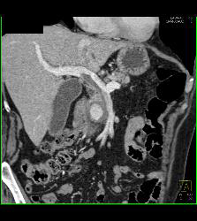 Gastroduodenal Artery (GDA) Pseudoaneurysm Simulates An Islet Cell Tumor - CTisus CT Scan