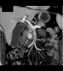 Gastroduodenal Artery (GDA) Pseudoaneurysm Simulates An Islet Cell Tumor - CTisus CT Scan