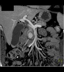 Gastroduodenal Artery (GDA) Pseudoaneurysm Simulates An Islet Cell Tumor - CTisus CT Scan