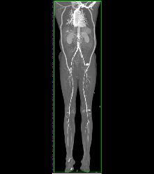 Flash Runoff in Under 5 Seconds - CTisus CT Scan