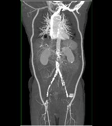 Flash Runoff in Under 5 Seconds - CTisus CT Scan