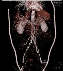 Flash Runoff in Under 5 Seconds - CTisus CT Scan