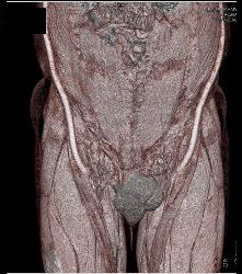 Flash Runoff in Under 5 Seconds - CTisus CT Scan