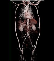 Flash Runoff in Under 5 Seconds - CTisus CT Scan