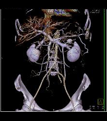 3D of Mesenteric Arcade - CTisus CT Scan