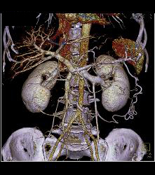 3D of Mesenteric Arcade - CTisus CT Scan