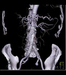 Endovascular Stent With Endoleak - CTisus CT Scan