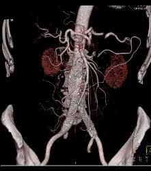 Endovascular Stent With Endoleak - CTisus CT Scan