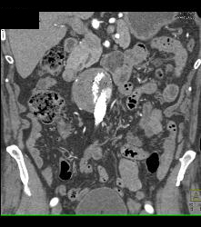 Endovascular Stent With Endoleak - CTisus CT Scan