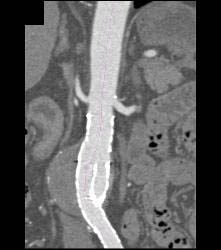 Endovascular Stent With Endoleak - CTisus CT Scan