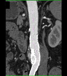 Endovascular Leak From Stent- Type Ii - CTisus CT Scan