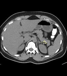 Splenic Artery Aneurysm Simulates An Islet Cell Tumor - CTisus CT Scan